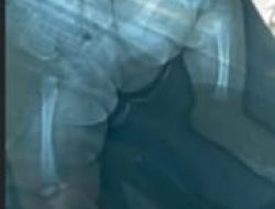 Sadis, Ayah Kandung di Kecamatan Sp Rimba Aniaya Anaknya Hingga Patah Tulang Paha