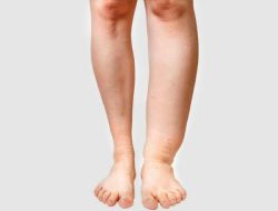 Waspada! Penyakit Kaki Gajah Bisa Sebabkan Cacat Permanen